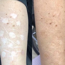 Permanentní make-up na jizvy a šramy