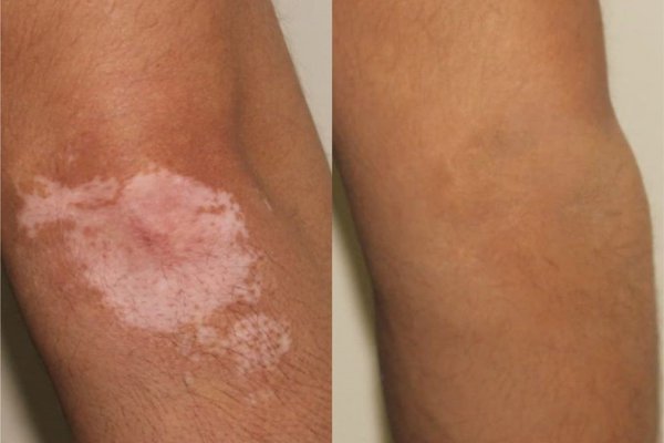 scar-camo-before-and-after-01-1024x910.jpg